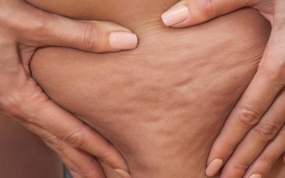 Cellulite